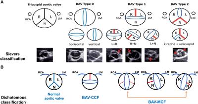 Bicuspid Aortic Valve: An Update in Morphology, Genetics, Biomarker, Complications, Imaging Diagnosis and Treatment
